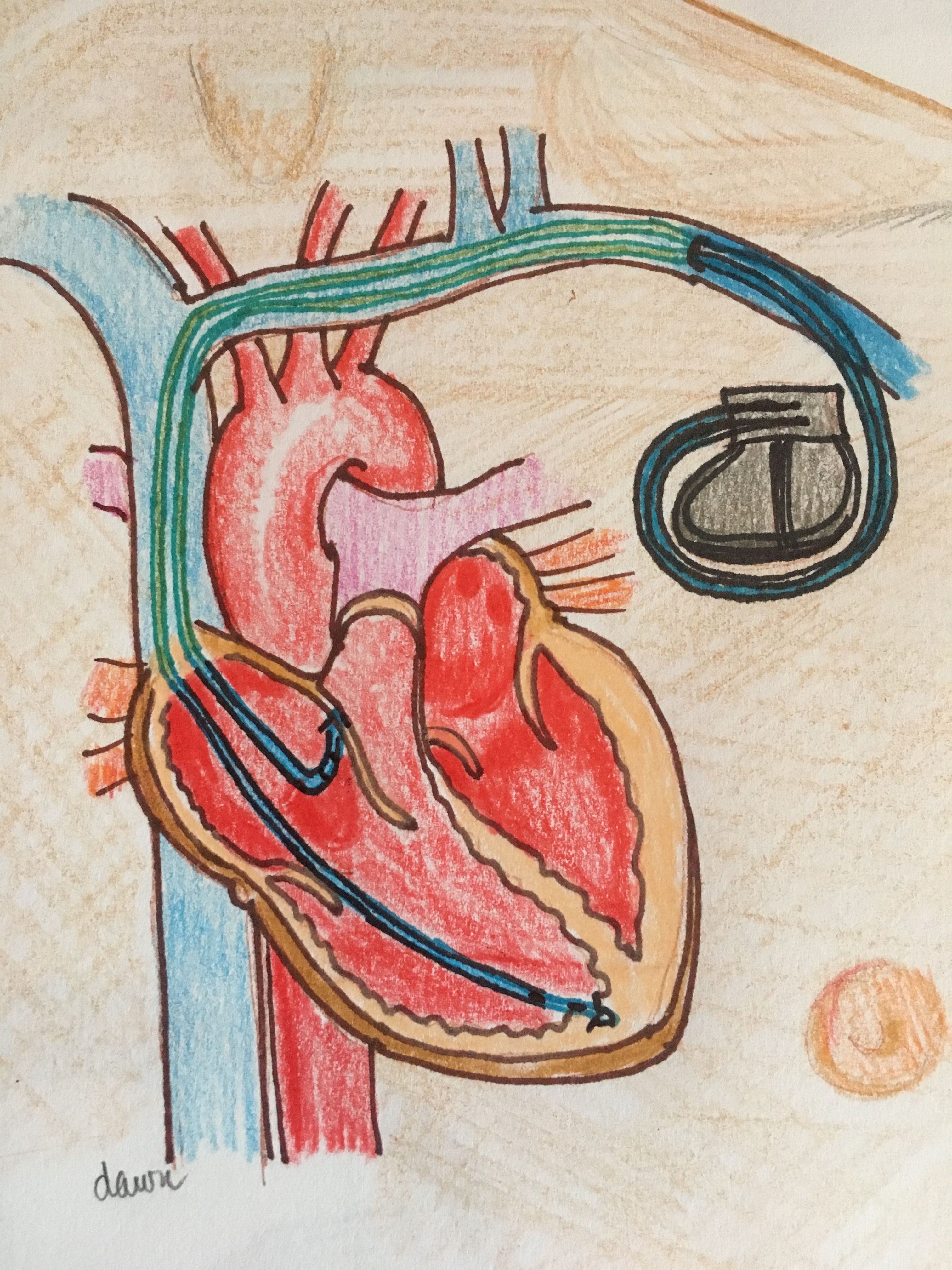 Dual chamber pacemaker illustration ECG Guru Instructor Resources